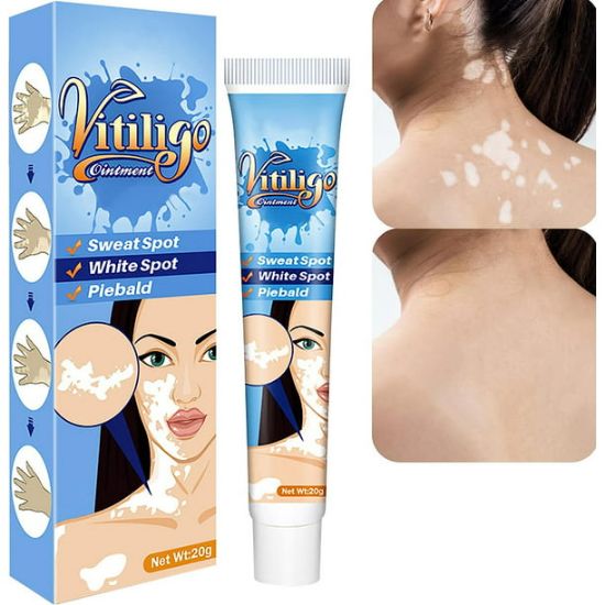 Picture of Vitiligo Cream, Vitiligo Treatment for Skin Vitiligo, Vitiligo Care Cream for Reduce White Spots and Improve Skin Pigmentation